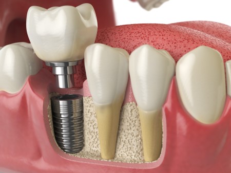 dental implant crown illustration