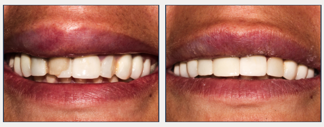 See our before and after photo gallery - Highpoint Dental Care and Implant Center