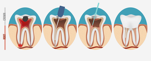 Root Canal Treatment illustration